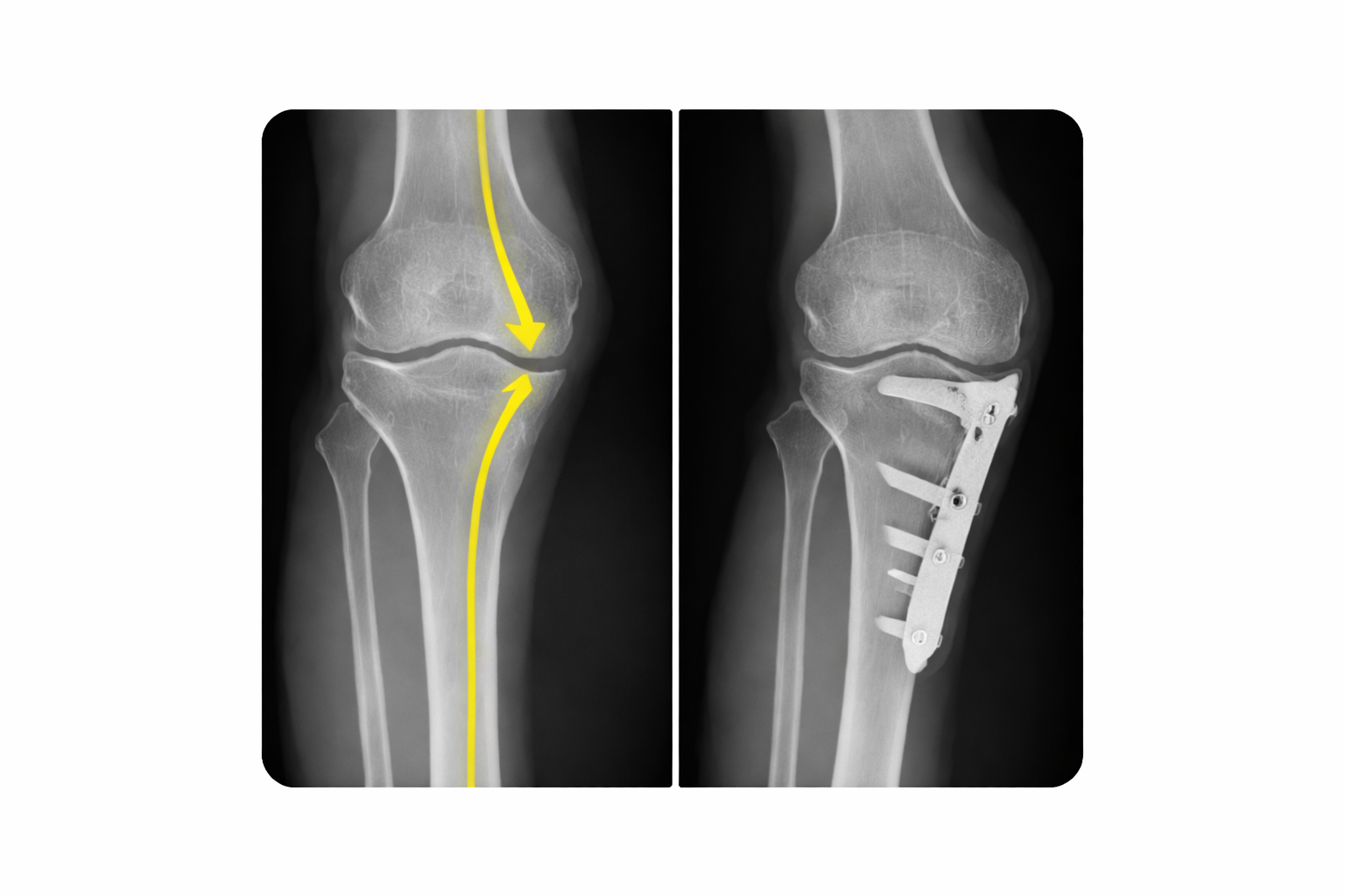 Joint Deformity Correction at Trinay Orthopedic Hospital, Ahmedabad